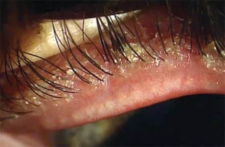 Nużeniec na rzęsach objawy – jak rozpoznać i uniknąć problemów ze wzrokiem